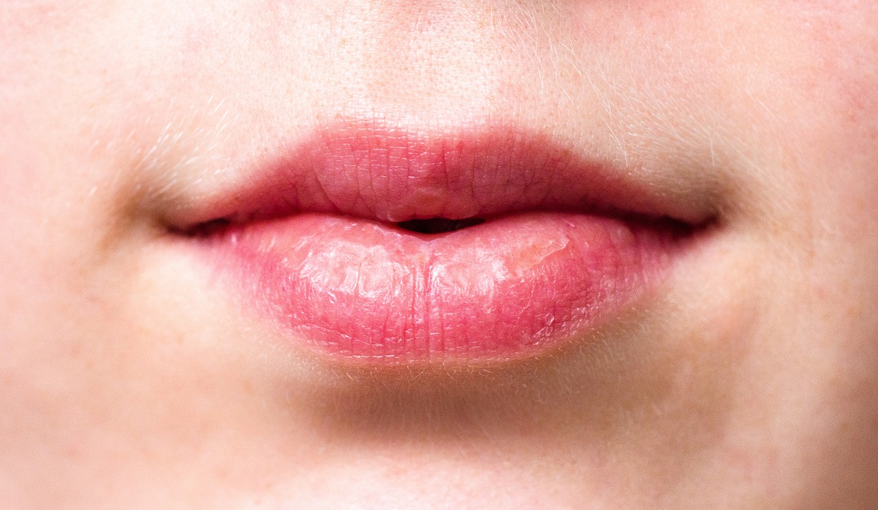 How to Prevent and Treat Chapped Lips
