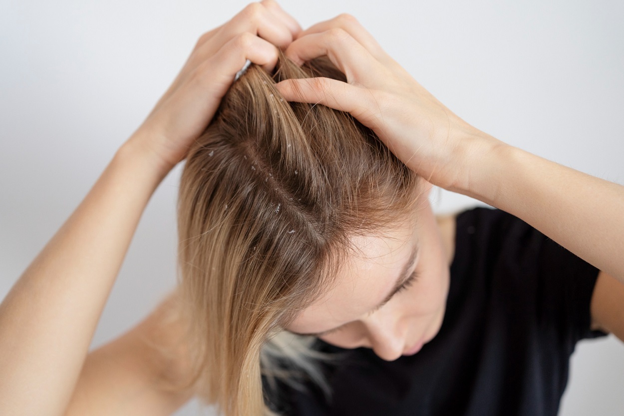 How to Get Rid of Dandruff: A Seriously Silky Guide
